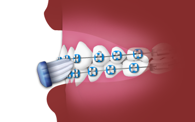 Brushing with braces